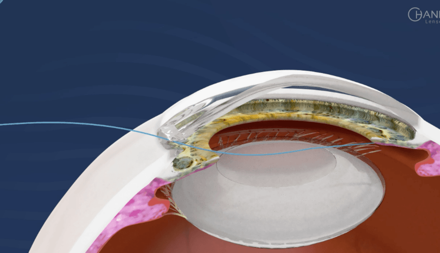 AssiAnchor Animation