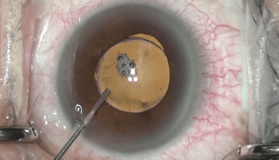 Cataract surgery video by Dr Kim, presented in Vienna ESCRS